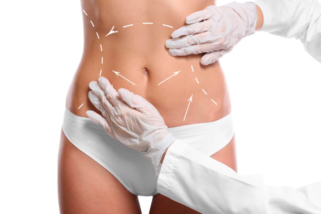 Doğum Sonrası Liposuction Sonuçları Kalıcı Mı? 3