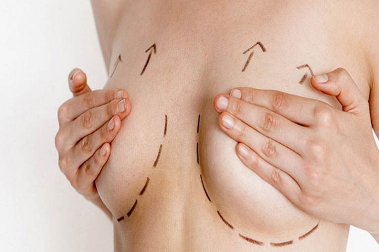 Sarkmış Göğüsler İçin Estetik Ameliyat 3