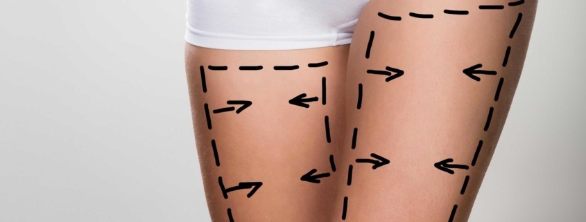 Bacak Yağı Aldırma Ameliyatı ( Liposuction )