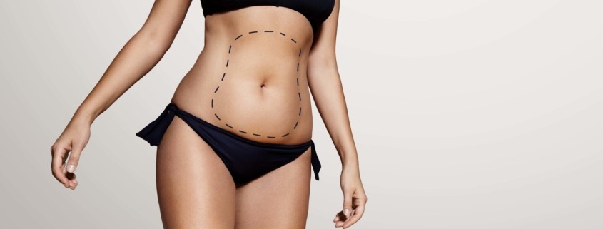 Liposuction Ameliyatı Nasıl Yapılır?