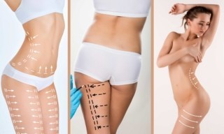 Liposuction Hangi Bölgelere Uygulanır?