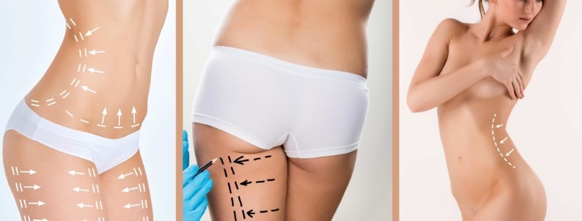 Liposuction Hangi Bölgelere Uygulanır?