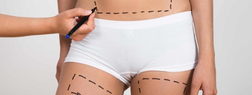 Liposuction Zararları Var Mıdır?