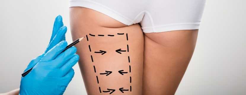 Liposuction Surgery in Turkey