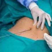 Liposuction Ameliyat Öncesi ve Sonrası Dikkat Edilmesi Gerekenler
