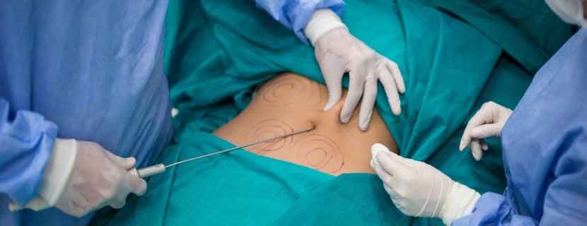 Liposuction Ameliyat Öncesi ve Sonrası Dikkat Edilmesi Gerekenler