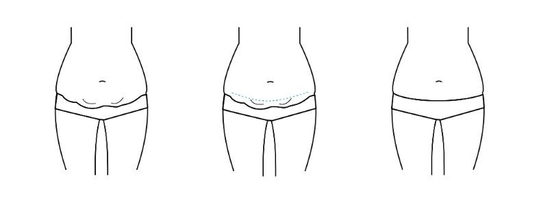 tummy tuck before and after process