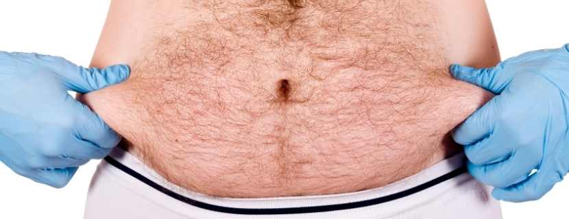 Erkekler Liposuction Yaptırabilir Mi?
