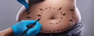 Liposuction Sonrası İz Kalır Mı?