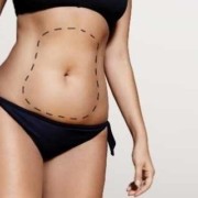 Liposuction Sonrası İz Kalır mı_