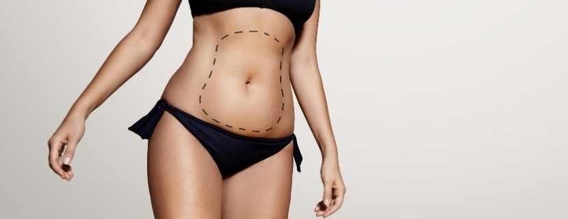 Liposuction Sonrası İz Kalır mı?