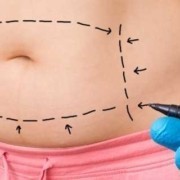 How Much Tummy Tuck Surgery Cost on Average Abroad