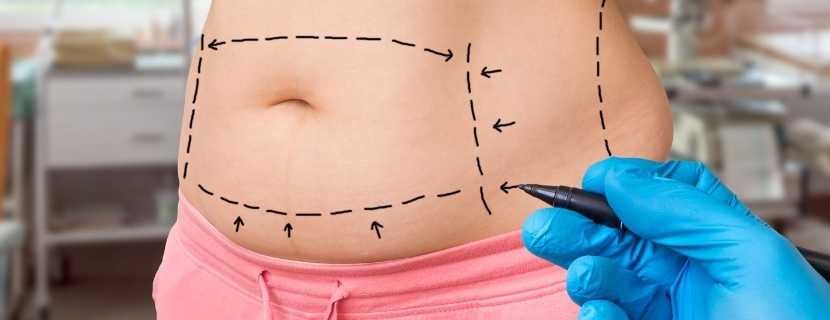 How Much Tummy Tuck Surgery Cost on Average Abroad