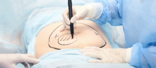 Yağ Aldırma (Liposuction) için hangi doktora/bölüme gidilir?