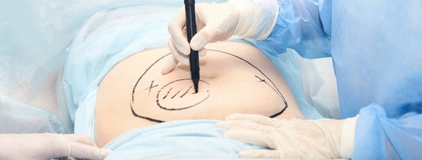 Yağ Aldırma (Liposuction) için hangi doktora/bölüme gidilir?