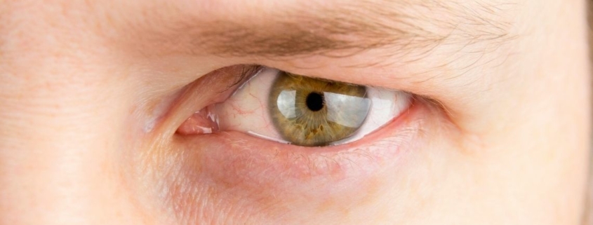 Ameliyatsız Göz Kapağı Düşüklüğü Tedavisi Mümkün Mü?